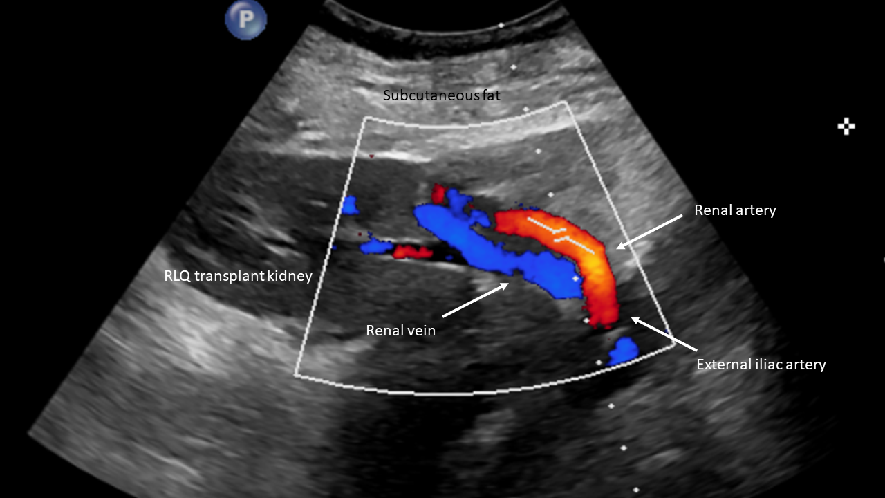 Renal vascular anatomy illustrated in a right lower quadrant transplant kidney with the external iliac artery representing the vascular anastomosis site. 