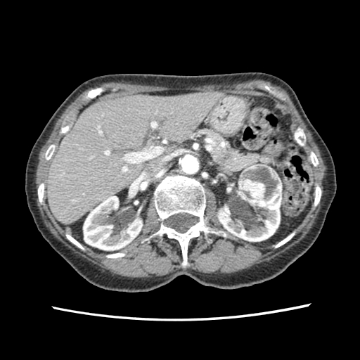 CT Abdomen Bosniak IV Left Renal Cell Lesion Consistent with Renal Cell Carcinoma