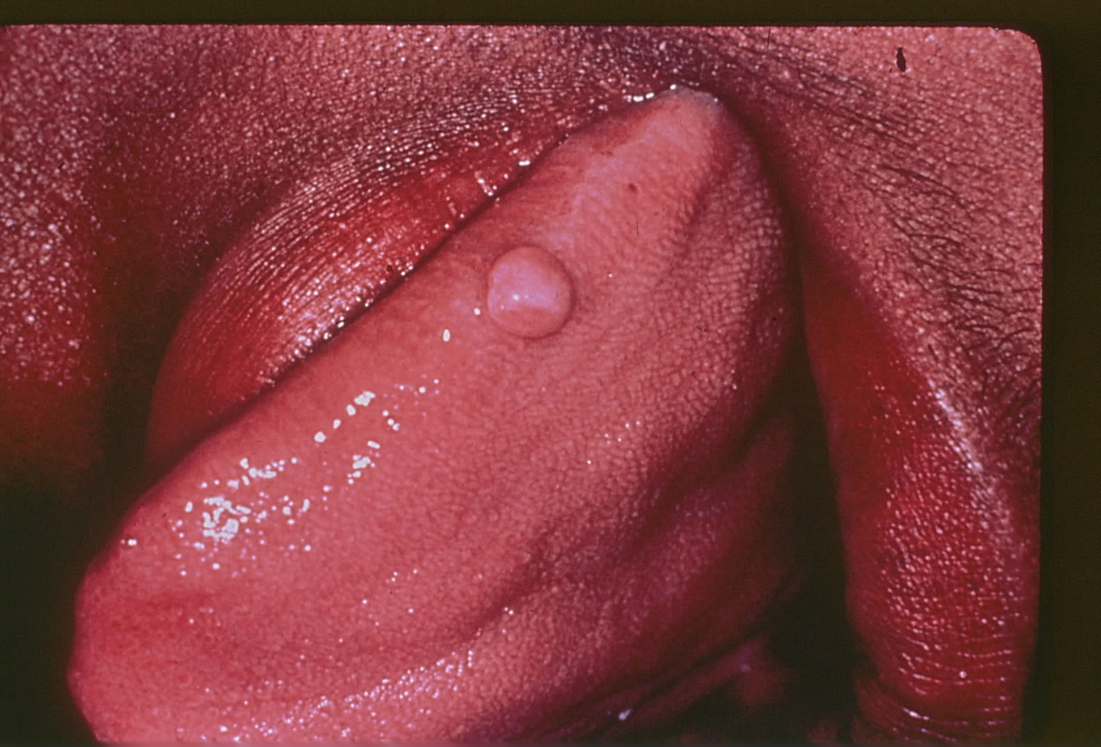 Traumatic fibroma noted on the tongue