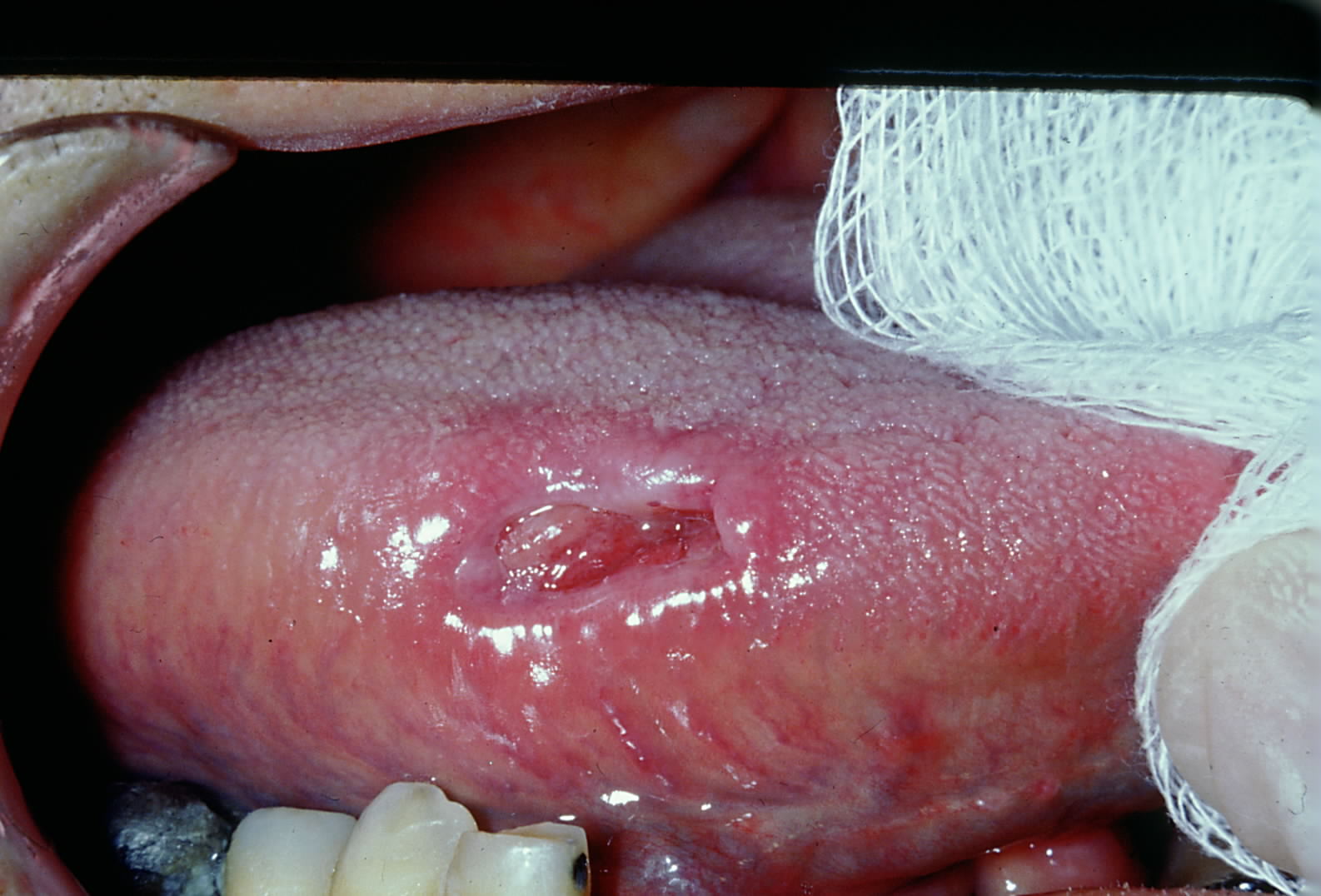 Traumatic ulcerative granuloma with stromal eosinophilia located on the tongue.