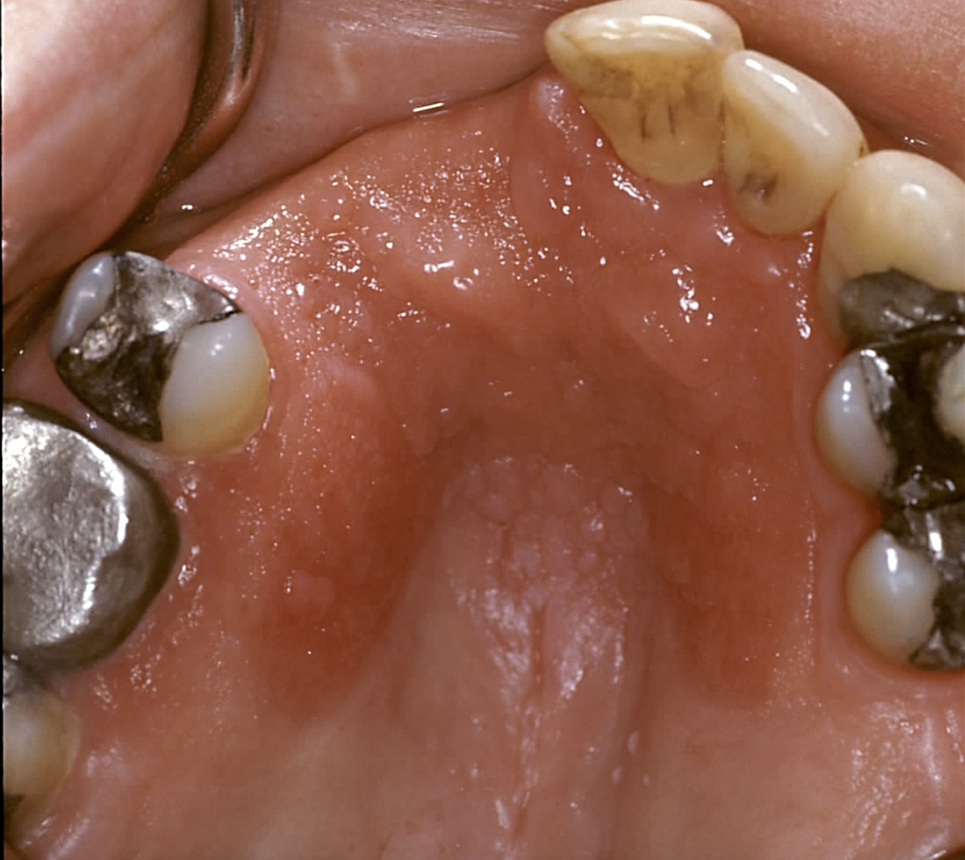 Inflammatory papillary hyperplasia noted on the hard palate of a denture wearer
