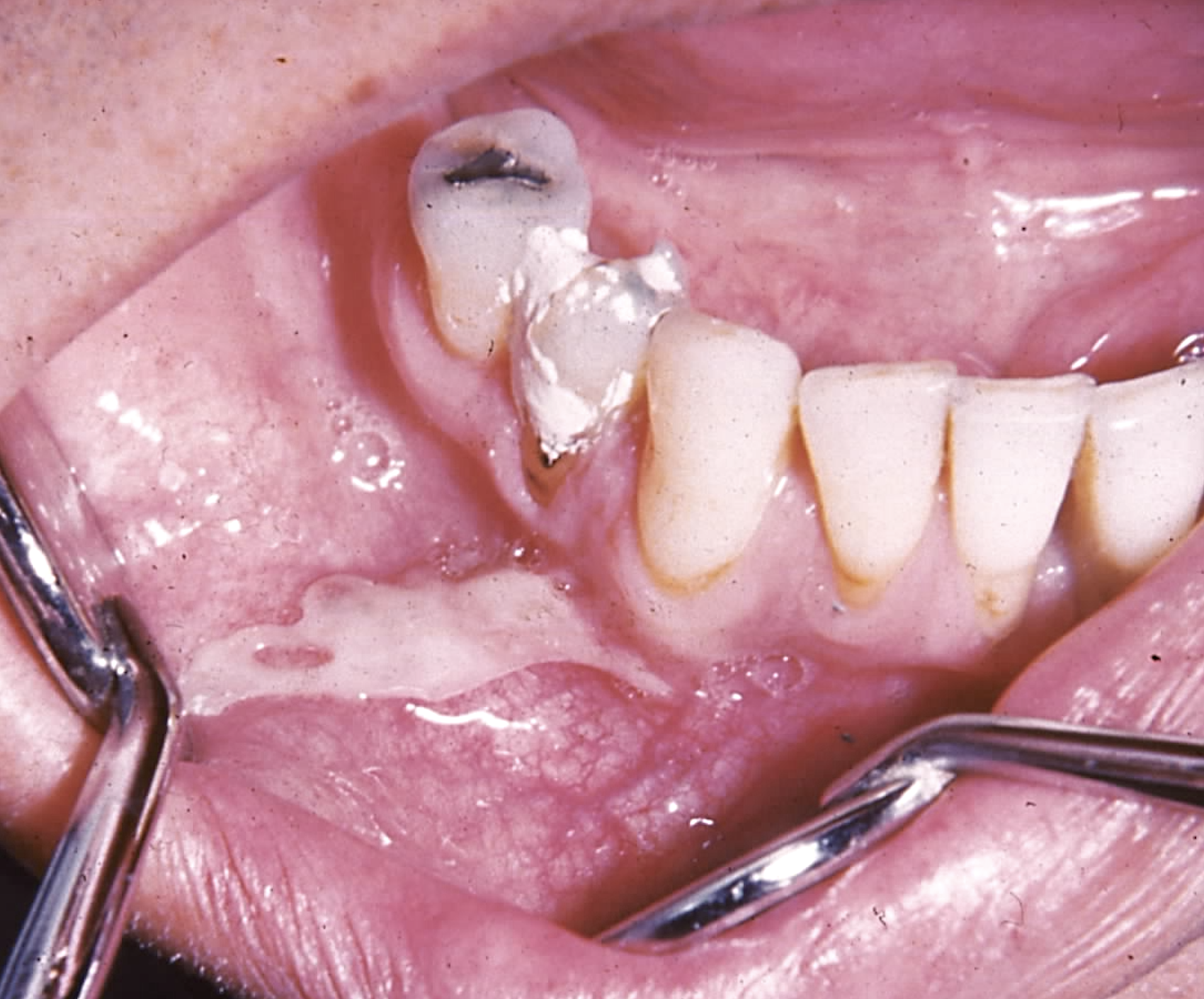Aspirin induced chemical burn noted on the buccal mucosa, with noted residual aspirin present on teeth