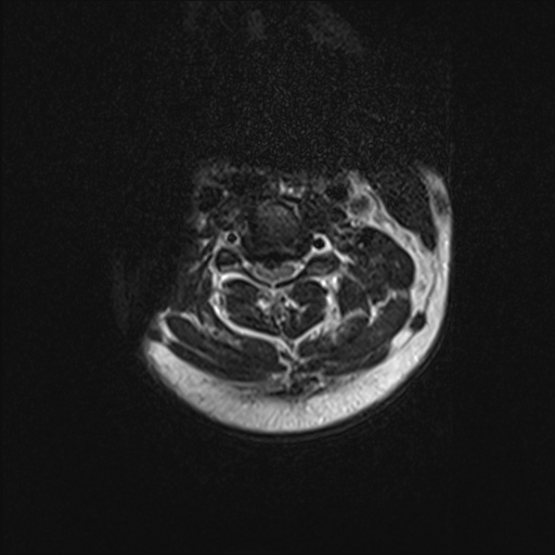 Cervical Spine MRI Central Disc Herniation Protrusion