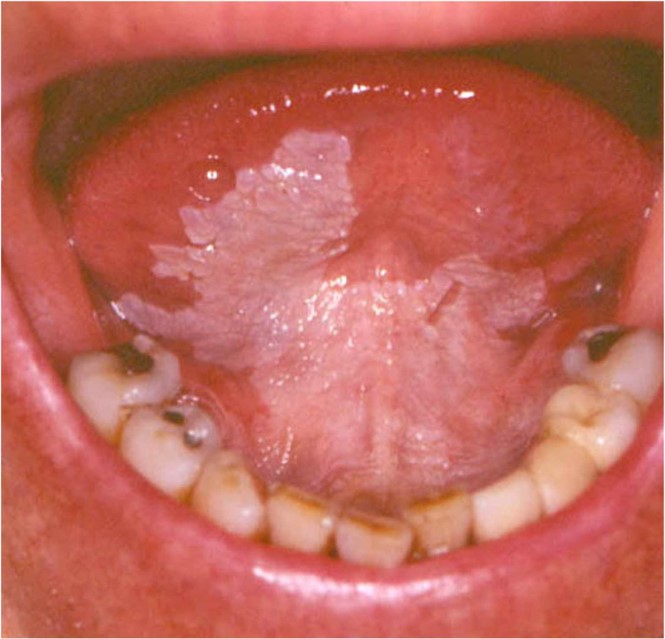 Leukoplakia of the ventral tongue and floor of mouth