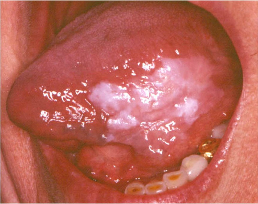 Leukoplakia of the lateral border of the tongue