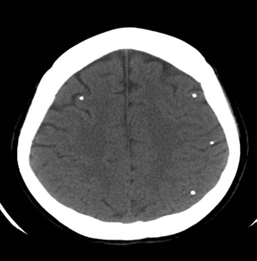 CT Head neurocysticercosis