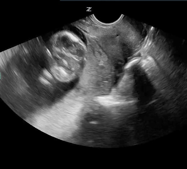 Transvaginal ultrasound demonstrating placenta previa