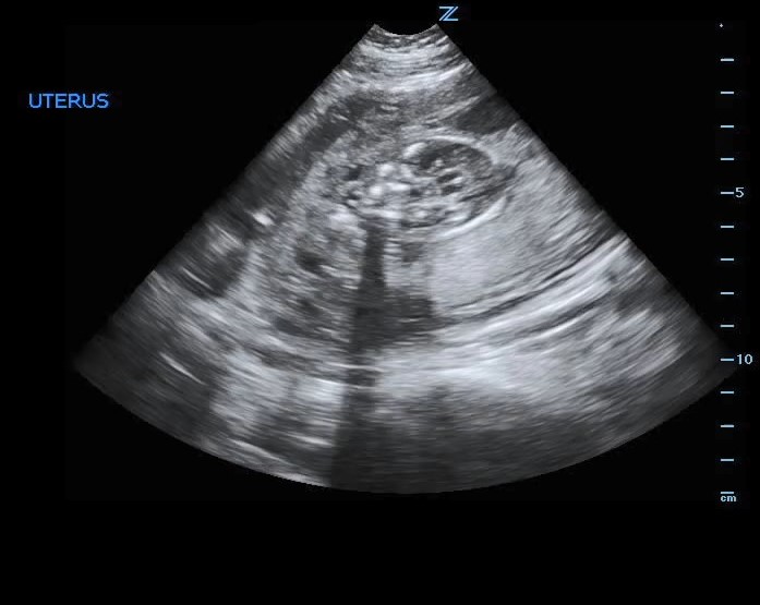 Third trimester pregnancy ultrasound with oligohydramnios