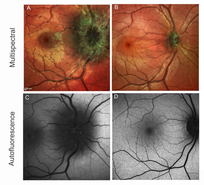 Neuroretinitis in an 18-year-old female who presented with vision loss in the right eye, headaches and severe photophobia

A: Multispectral image shows right optic nerve edema at presentation

B: Shows resolution of the edema

C: Fundus autofluorescence of the right eye on presentation shows hypoautofluorescence surrounding the optic nerve

D: Improvement of the hyposutofluorescence with resolution of the condition
