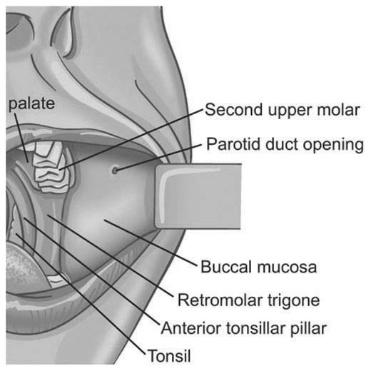 Anatomical limits of the buccal mucosa showing the opening of the parotid duct opposite the second upper molar tooth