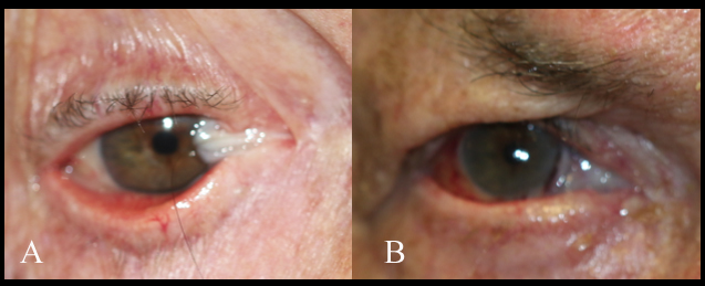Split-thickness mucous membrane graft for reconstruction of medial cants and superior and inferior fornix.

A: Patient who has had multiple attempts at aggressive recurrent medial pterygium resection and repair. He presents with scarring of the superior and inferior fornices with marked limitation of right globe movement.

B: Six months after extensive resection of scar tissue and reconstruction of the superior and inferior fornix and bulbar defect with split-thickness mucous membrane graft giving the patient single vision in primary gaze and improvement in his abduction with better eyelid closure and comfort. Note that the split-thickness mucous membrane graft does not generally remain pink after a few months