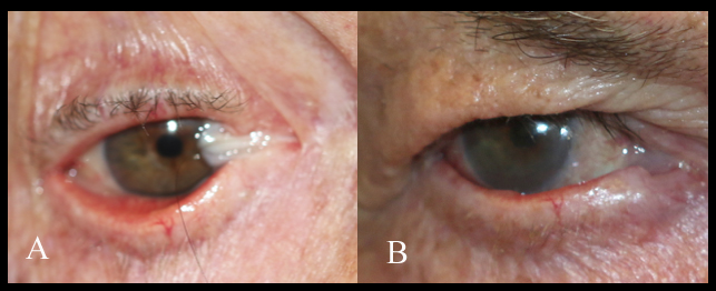 Patient one year after reconstruction of the right superior and inferior fornix, bulbar scarring, double vision and corneal scarring. Split-thickness mucous membrane grafts were used. Note the eventual normalization of the color of the split-thickness mucous membrane grafts