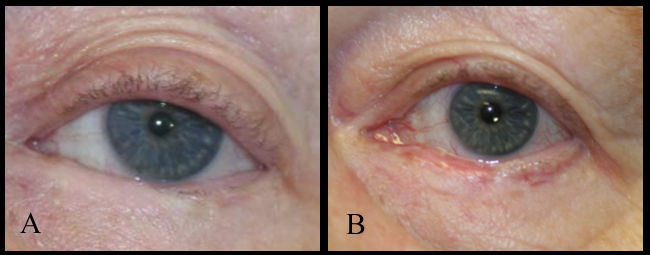 Repair of cicatricial lower eyelid entropion with mucous membrane graft

A: Patient with ocular cicatricial pemphigoid that is well controlled but has a painful left eye because of the cicatricial left lower entropion and symblepharon formation

B: After correction of the symblepharon and the entropion with anterior lamellar repositioning, release of the symblepharon and repair with mucous membrane graft
