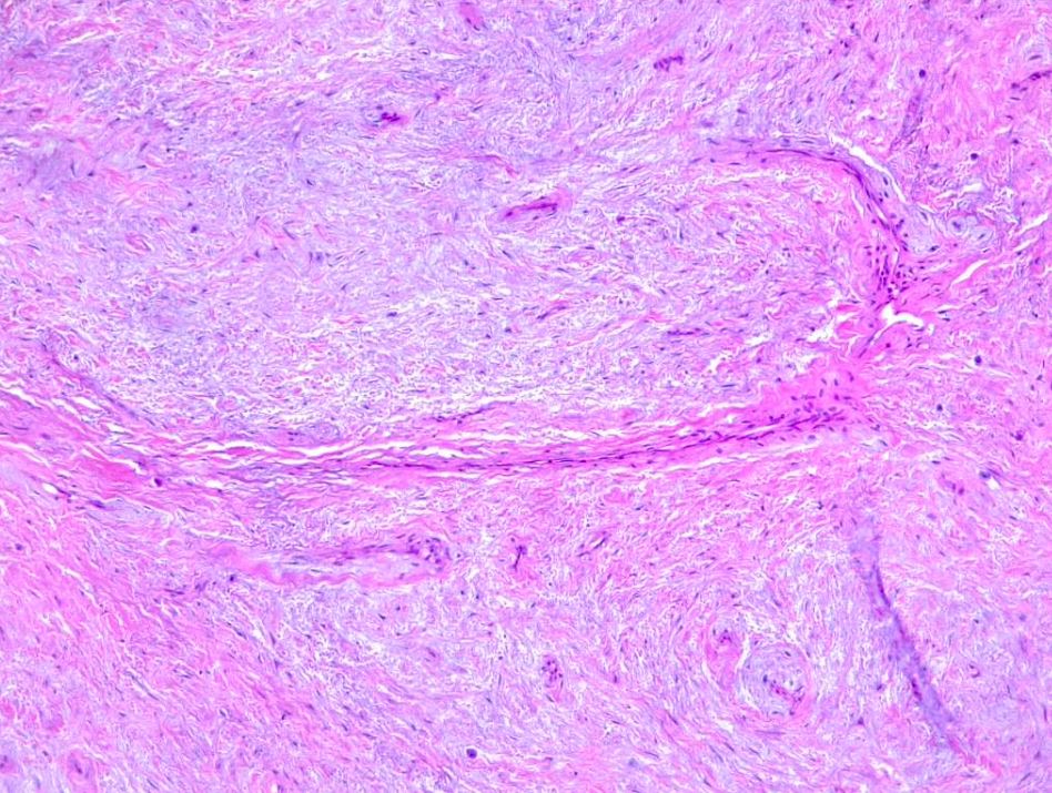 Myxofibrosarcoma. Arciform vessels in a low grade sarcoma setting