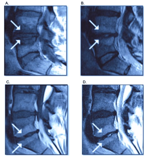 Figure 2. Magnetic resonance image (MRI) of the lumbar spine demonstrating type 1 (A, B) and type 2 (C,D) vertebral endplate damage with Modic changes. The white arrows point to the signaling changes on different MRI sequences. Modic changes type 1 with hypodense or decreased signal intensity of fibrovascular intraosseous bone marrow edema on T1-weighted MRI sequence and as hyperintense or increase signal intensity on T2-weighted MRI sequence, while Modic type 2 shows increased signal intensity in both T1 and T2 MRI sequence images. 