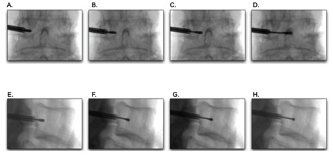 Figure 3. Transpedicular approach with safe needle advancement and placement visualized in an anterior-posterior (A-D) and lateral (E-H) fluoroscopy views towards the anatomical target. 