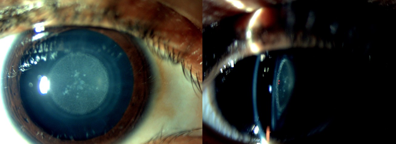 Pediatric Zonular cataract, diffuse and oblique illumination on slit lamp examination