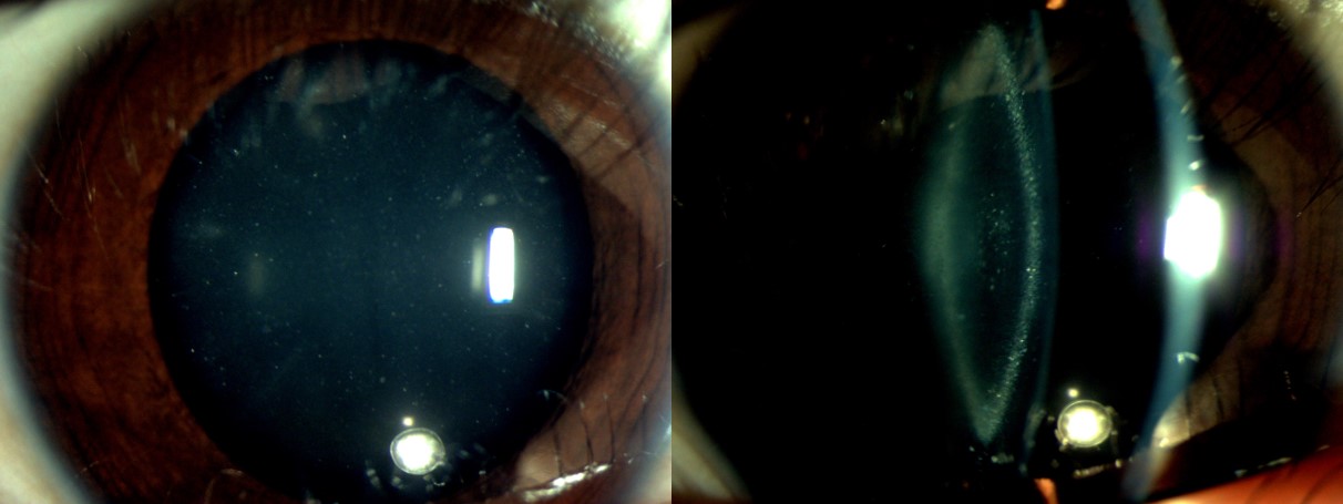 Pediatric Cataract. This slit lamp photograph depicts zonular type of pediatric cataract with blue dot cataract component.