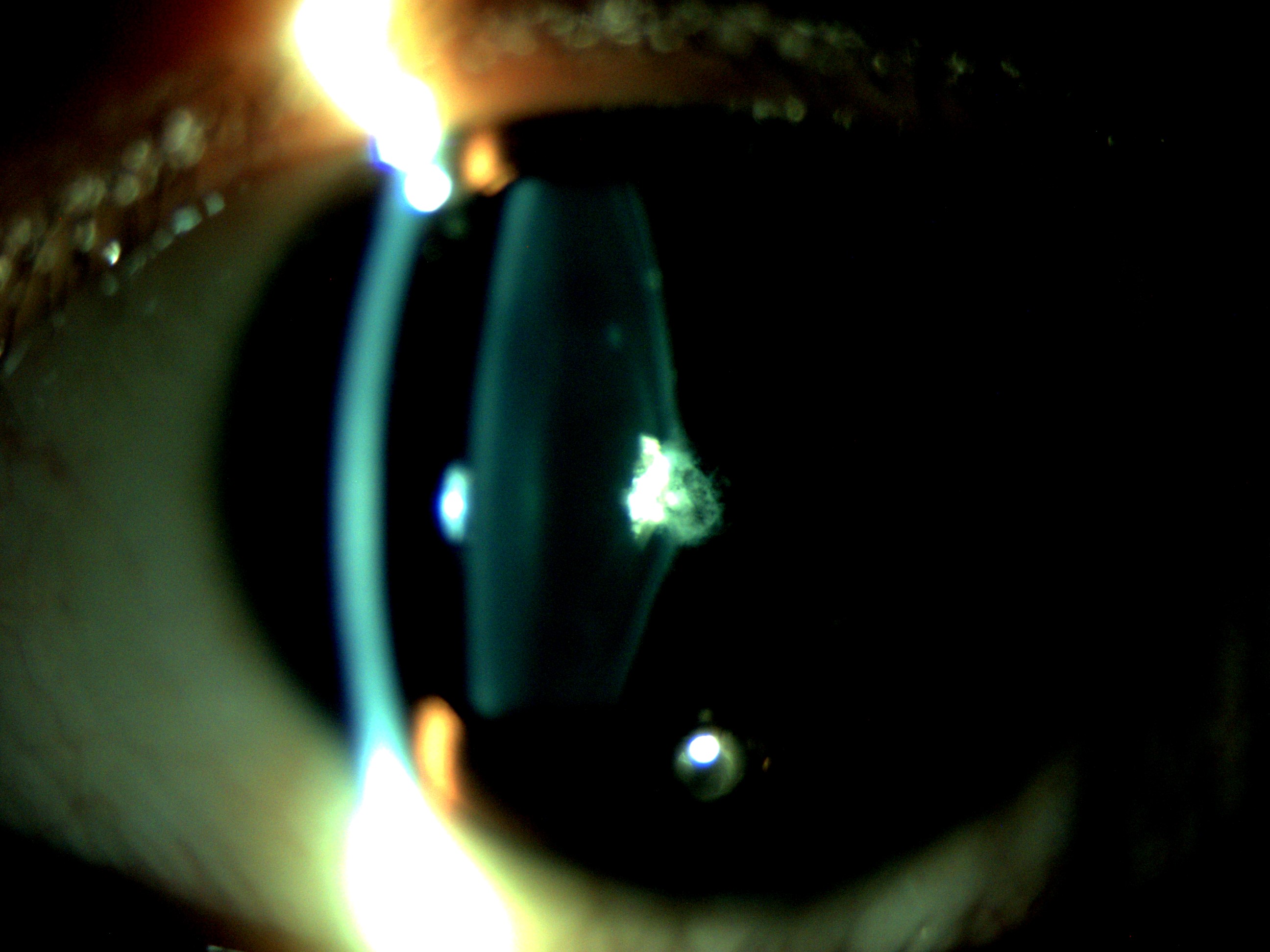 Pediatric cataract. Posterior lenticonus. This slit lamp photograph shows posterior lenticonus variety of pediatric cataract. These, being close to the nodal point of eye affect visual acuity more than its anterior counterpart. Lowe syndrome is frequently associated with posterior lenticonus.