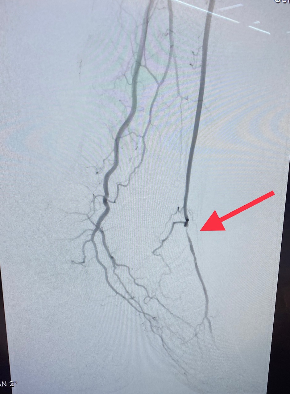 Peripheral Arterial Disease - High Grade Stenosis of Dorsalis Pedis Artery of the foot.