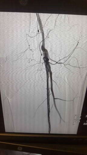 Peripheral Arterial Disease - Chronic Total Occlusion of Left Superficial Femoral Artery after atherectomy.
