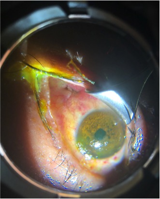 Image of a globe rupture just posterior to the lateral rectus muscle insertion site. The overlying conjunctiva has self-sealed, but remains hyperemic. 