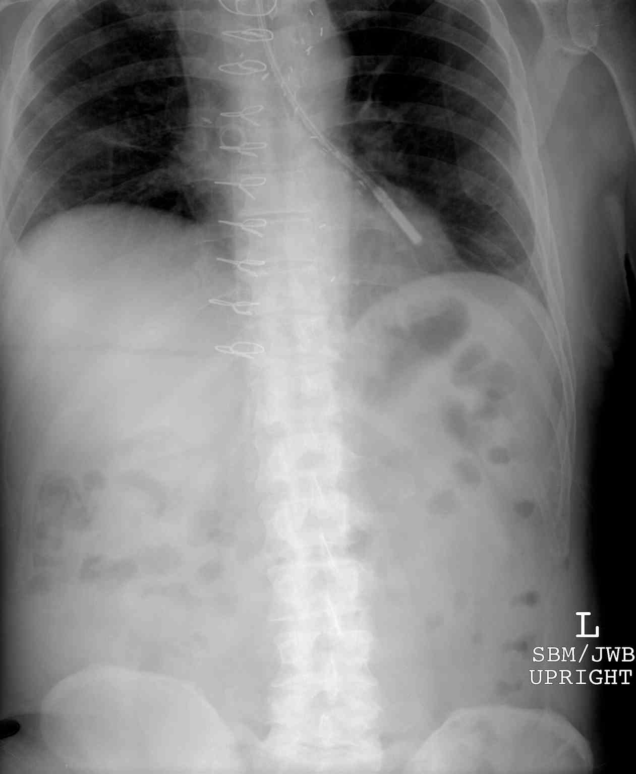 <p>Abdominal Radiograph, Feeding Tube in Left Mainstem Bronchus</p>