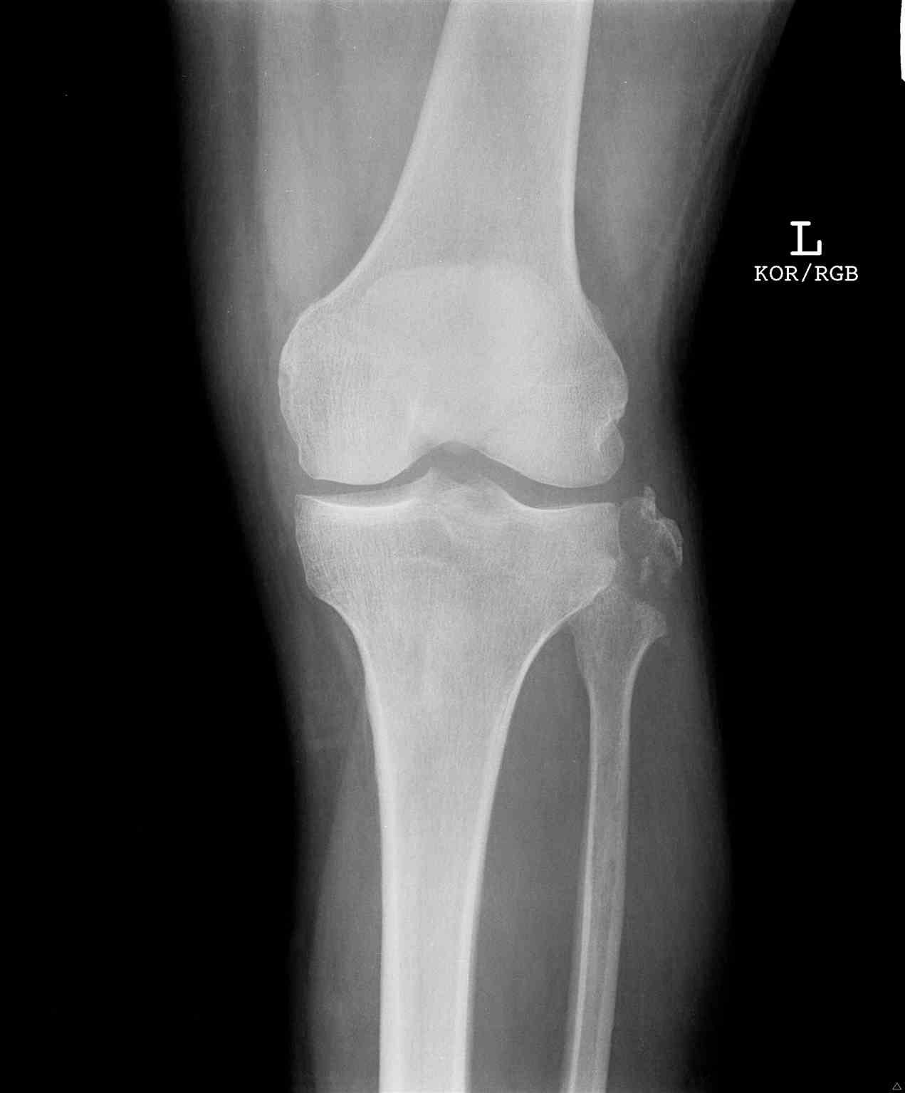 <p>Knee Radiograph, Fibular Avulsion Fracture</p>