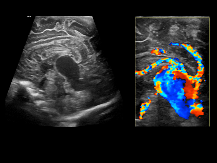 Sagittal gray-scale and color doppler images through midline show aneurysmally dilated vein of Galen with turbulent flow.