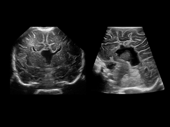 Coronal  gray-scale US images show absent corpus callous and widely separated frontal horns of lateral ventricles, giving characteristic "Texas longhorn" appearance
