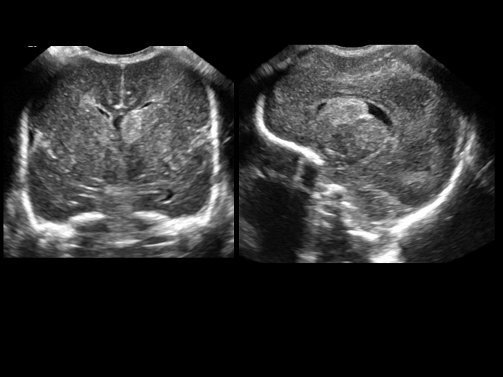 Left grade 1 hemorrhage. Coronal and sagittal gray-scale US image shows echogenic hemorrhage at left caudothalamic groove.