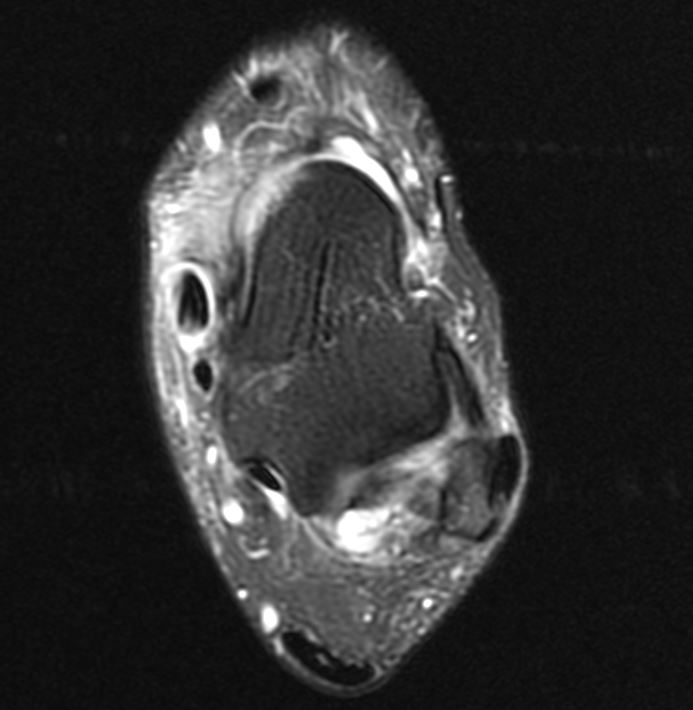 Posterior Tibial Tendon Dysfunction- MRI demonstrating extensive tenosynovitis of the posterior tibial tendon (PTT). No tears noted. Note the PTT is over double the size of the FDL tendon. 