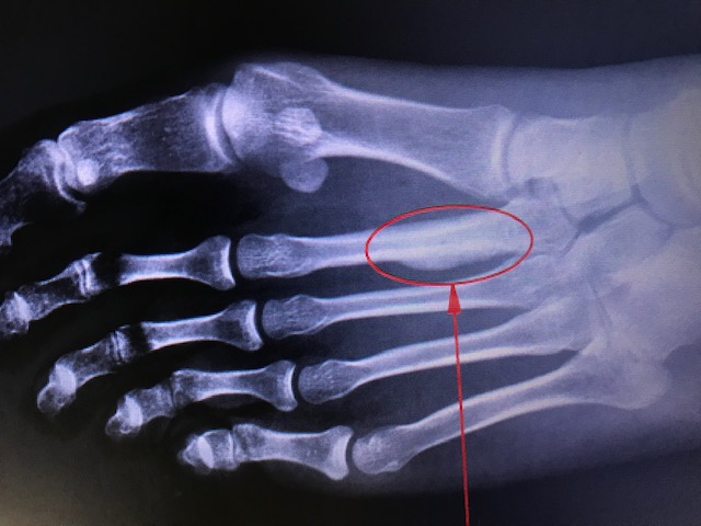 <p>March Fracture of Second Metatarsal</p>