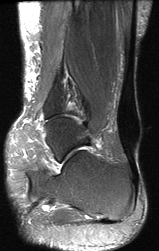 Achilles Tendonitis - MRI demonstrating classic fusiform thickening of the Achilles tendon in the "watershed" area