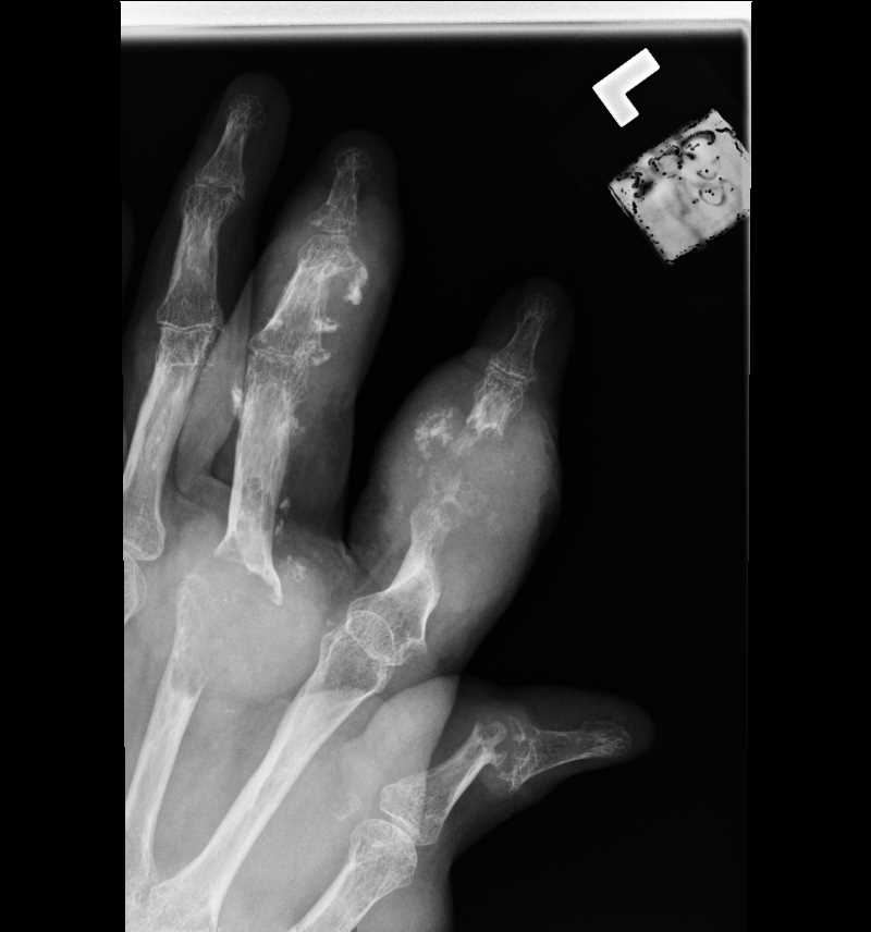 <p>Hand Radiograph, Gout</p>