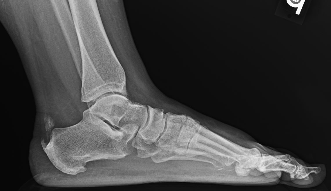 Achilles Tendonitis - lateral weight-bearing radiograph demonstrating a retro-calcaneal bone spur along with intra-tendinous calcification