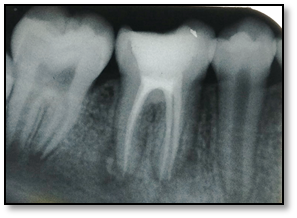 Periapical radiograph showing the endodontic obturation of 46.