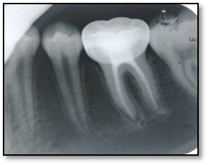 Stainless steel crown of 46 one-year follow-up radiograph.