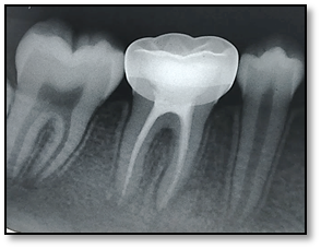Stainless steel crown in 46 two-month follow-up radiograph.