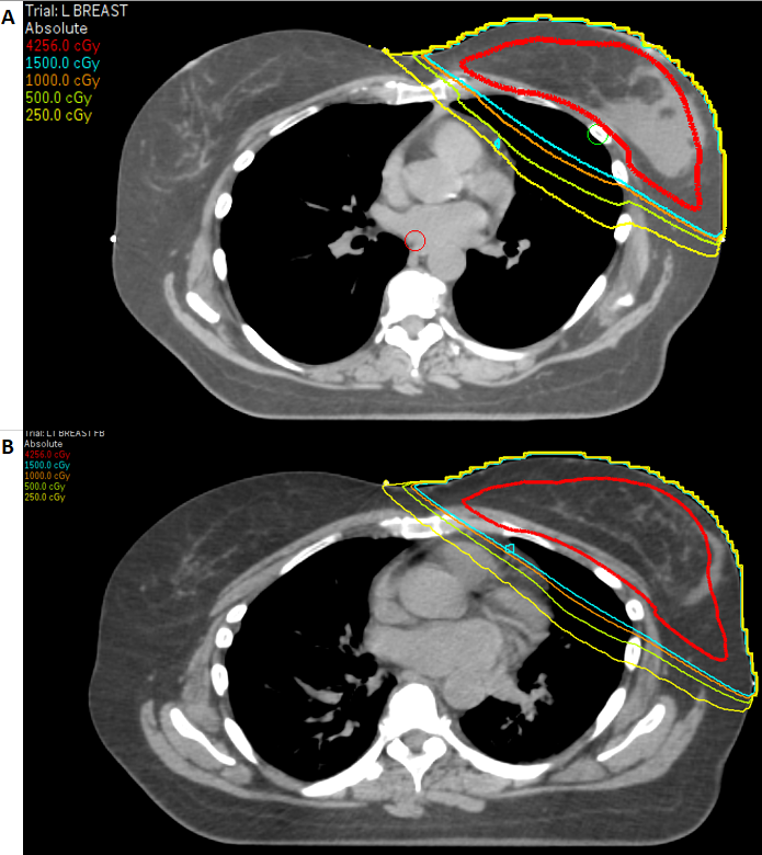 A comparison of the dose received by the left anterior descending artery (smallest circle in blue at the edge of the mediastinum) between a patient simulated in deep-inspiration breath-hold position vs. free-breathing.
*Matched at approximate level of the LAD