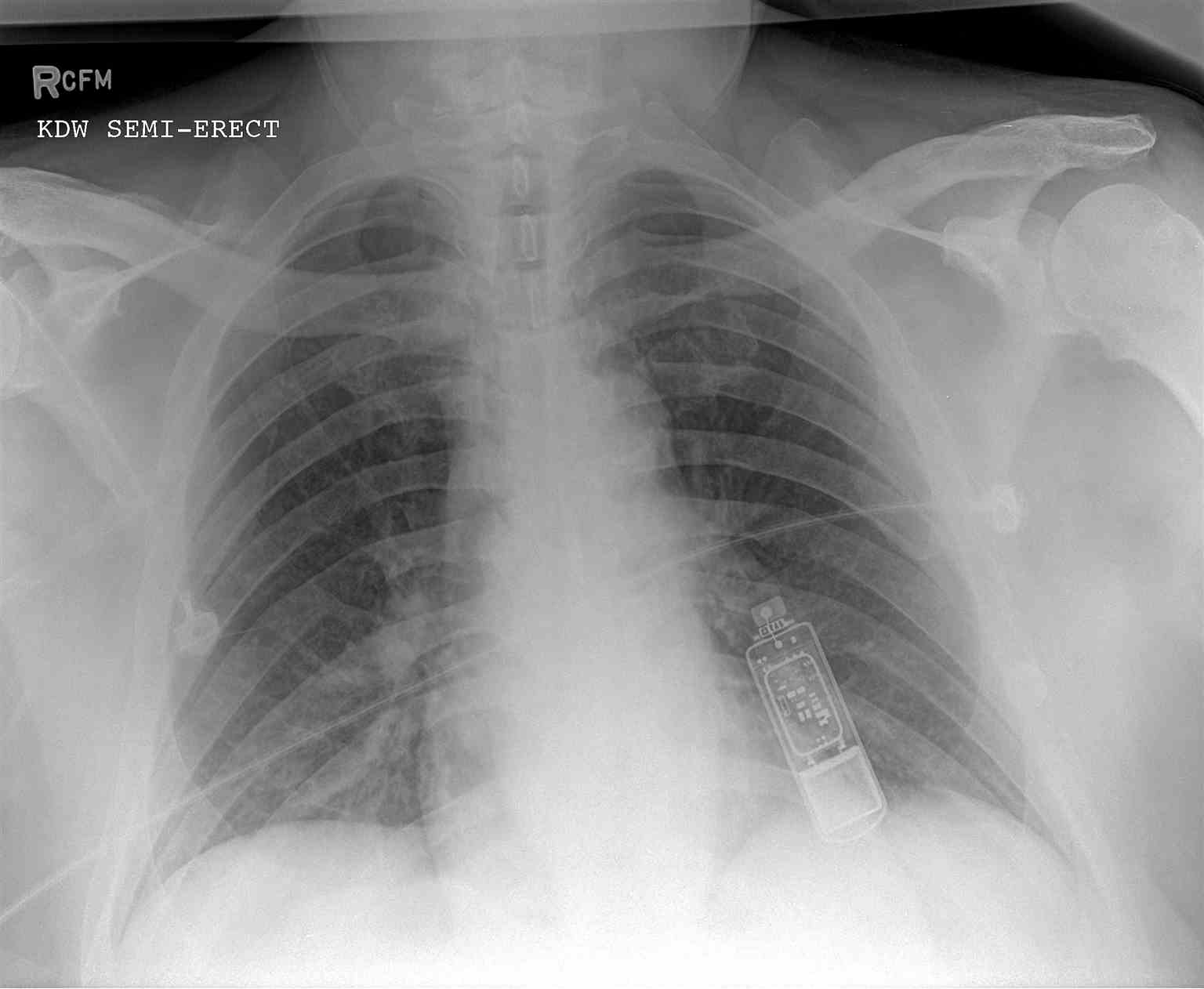 <p>Periapical (PA) Chest Radiograph, Implantable Loop Recorder</p>