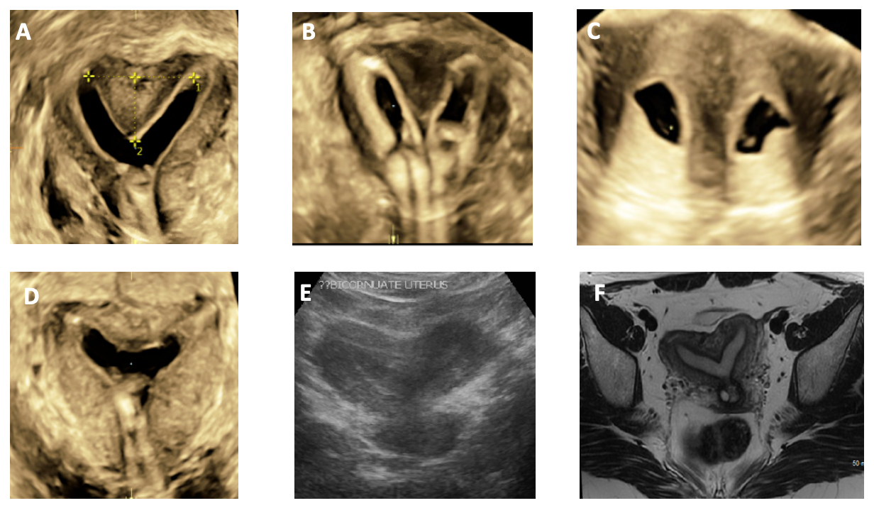 (A) 3D ultrasound coronal view of partial septate uterus,  (B) 3D ultrasound coronal view of a complete septate uterus, (C) U
