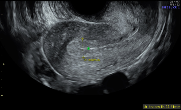 Figure 1: Sagittal view of uterus showing trilaminar endometrium, 