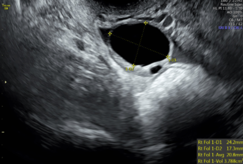 Figure 3: Transvaginal ultrasound image showing the ovary with a dominant follicle before ovulation trigger injection is administered