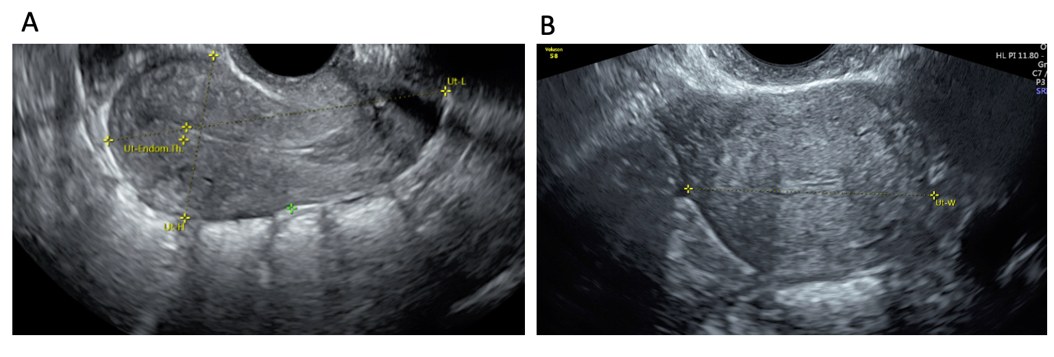 Figure 4: Transvaginal scan showing the uterine measurements in both (A) sagittal and (B) transverse planes