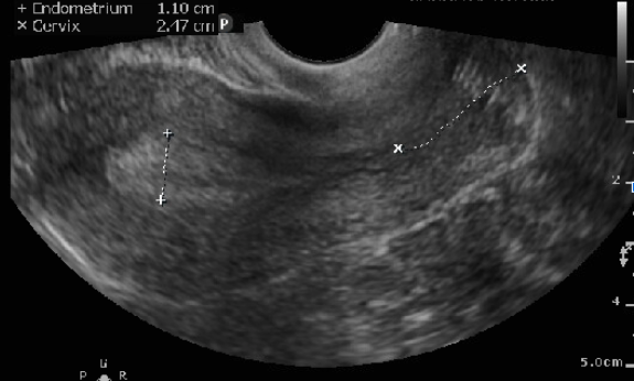 Figure 5: Midsagittal view of the uterus with its endometrium being measured perpendicularly from one echogenic to the other echogenic border at its thickest part 