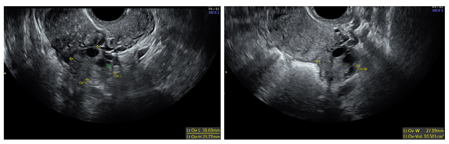 Figure 6: Transvaginal ultrasound image showing ovary and its measurements in three dimensions