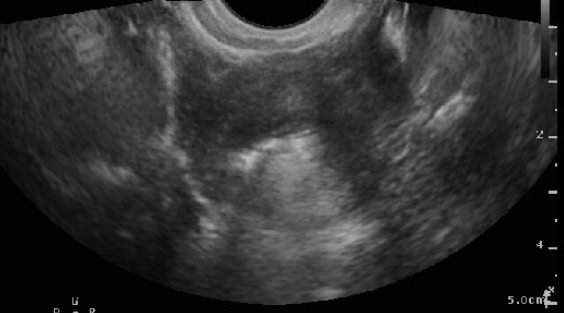 Figure 9:  SIS showing patent fallopian tube (hyper-echoic bubbles seen flowing through the cornua and outside of the uterine cavity)