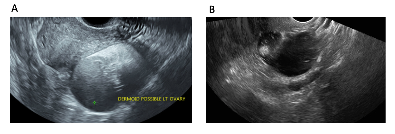 Figure 11: 2D transvaginal scan showing A) cystic teratoma with B) hyper-echoic Rokitansky nodule and hair