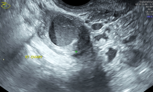 Figure 12: 2D transvaginal scan showing a hemorrhagic cyst or endometrioma